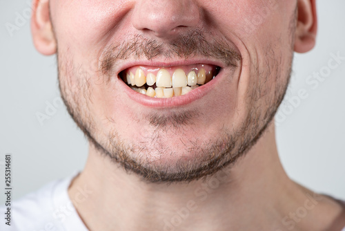 Foto A man with bristles and an open mouth with uneven teeth