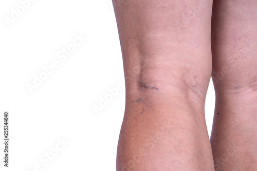 close up of Varicose veins on the woman legs isolate on white background with clipping path. Rear view. Vascular disease,varicose veins problems, health care and medical concept.