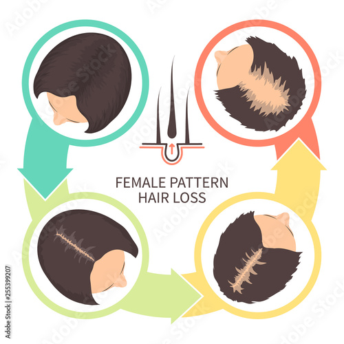 Female pattern hair loss set. Stages of baldness in women. Androgenetic alopecia infographic medical vector template for clinics and diagnostics centres.
