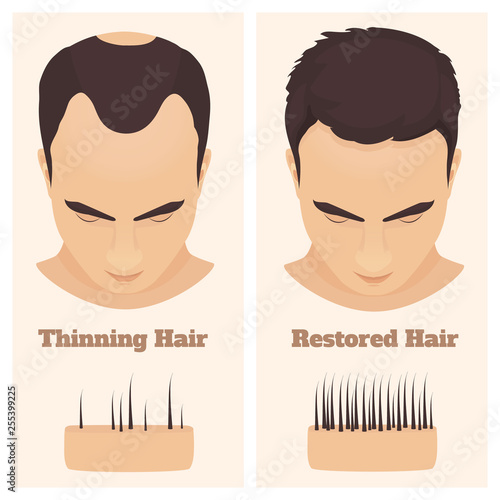 Man with thinning and restored hair. Male pattern alopecia set with skin cross-section diagram. Before and after concept. Vector illustration. 