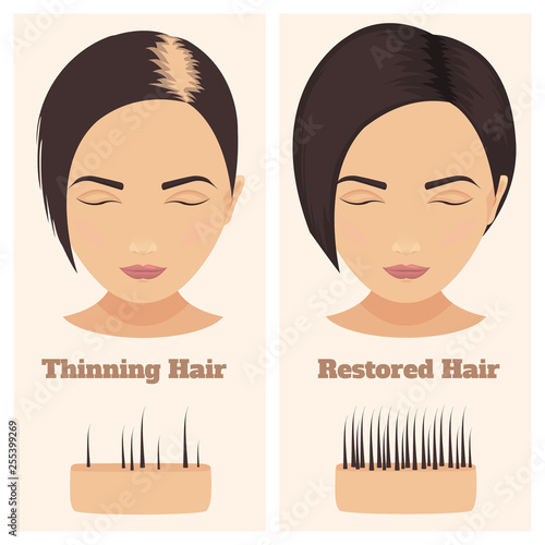 Woman with thinning and restored hair. Female pattern alopecia set with skin cross-section diagram. Before and after concept. Vector illustration. 