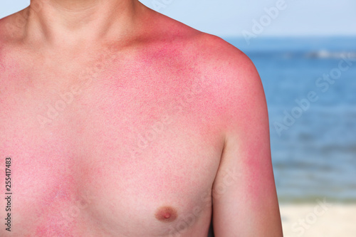 A man with reddened  itchy skin after sunburn. Skin care and protection from the sun s ultraviolet rays.