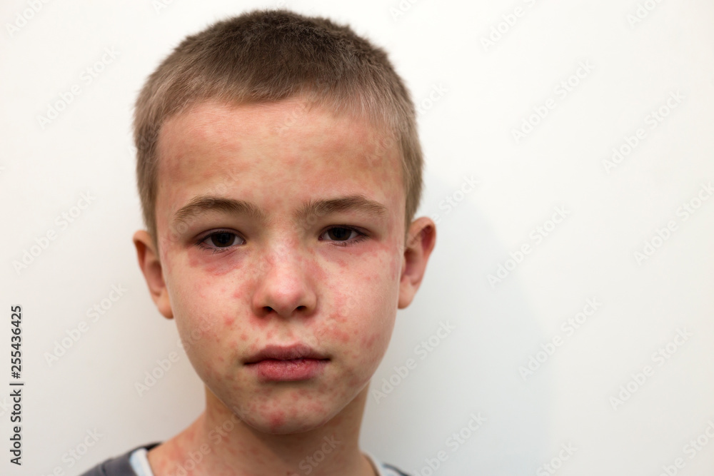 Fototapeta premium Portrait of sick sad boy child suffering from measles or chicken pox with bumps all over face. Contagious child diseases and treatment.