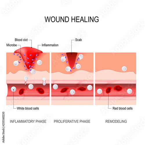 wound healing process. Tissue injury and inflammation. photo