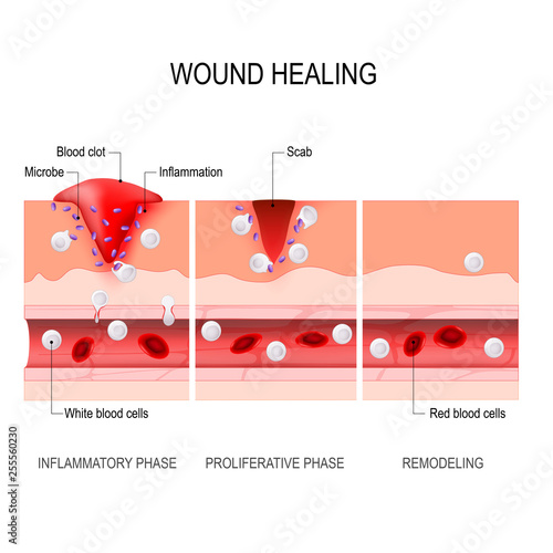 wound healing process. Tissue injury and inflammation.