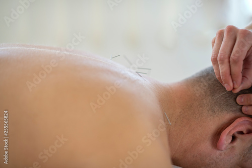 close up detail of acupuncture needles in back neck