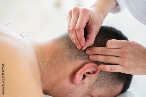 close up of mans ear acupuncture needle 