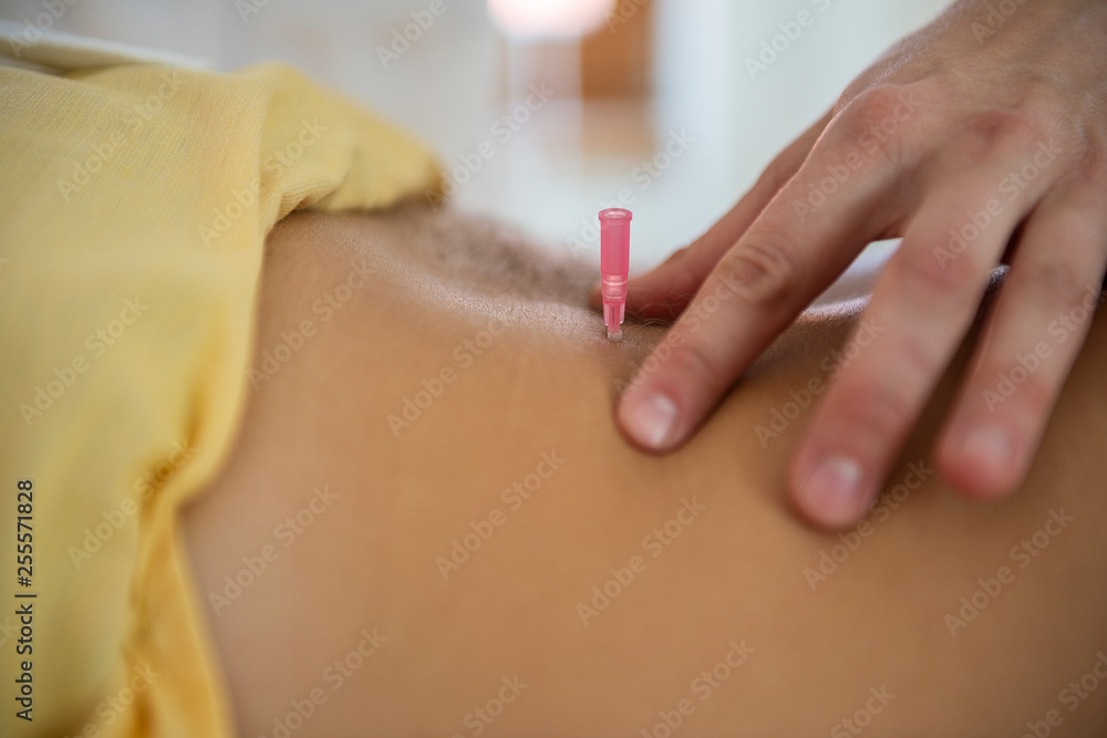 close up detail of acupuncture needles in back neck close up detail of acupuncture needles in back neck