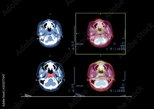 PET CT image of the brain showing CA nasopharynx or carcinoma of nasopharynx from PET CT scannner. photo