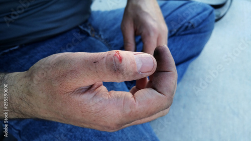 Hand wound on manual laborer
