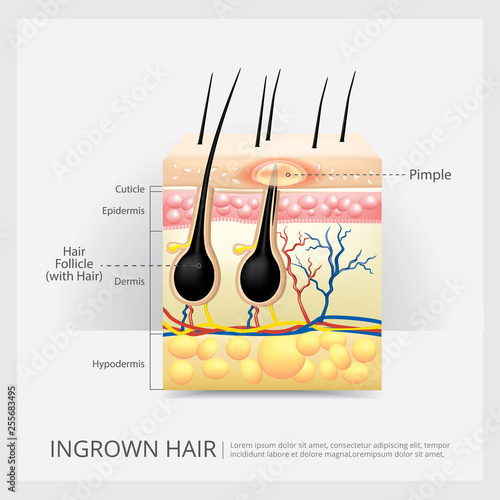 Hair Loss Structure Vector Illustration