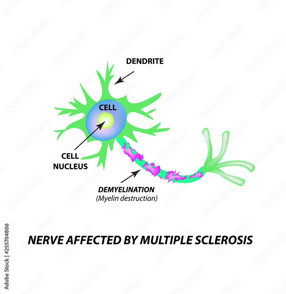 The Destruction Of The Myelin Sheath On The Axon Damaged Myelin The Destruction Of The Myelin Sheath On The Axon Damaged Myelin