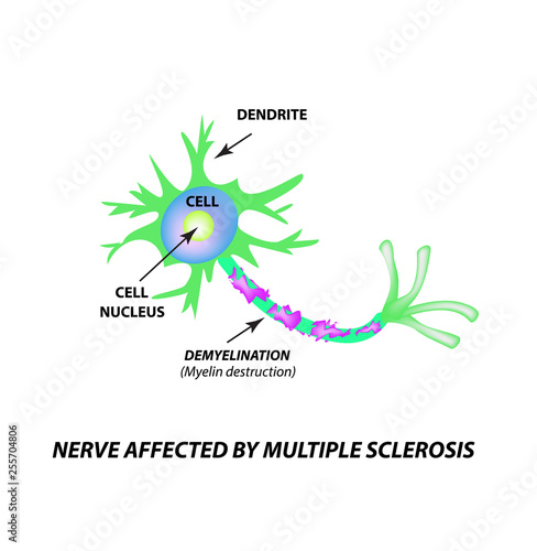 The destruction of the myelin sheath on the axon. Damaged myelin. Neuron affected by multiple sclerosis. World Multiple Sclerosis Day. Infographics. Vector illustration on isolated background. photo