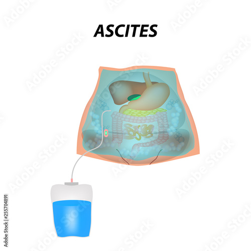 Ascites Free fluid in the abdominal cavity. Infographics. Vector illustration on isolated background. photo