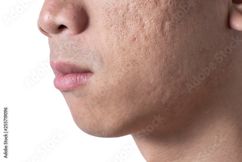 Close-up acne and scars on asian man face, isolated white background