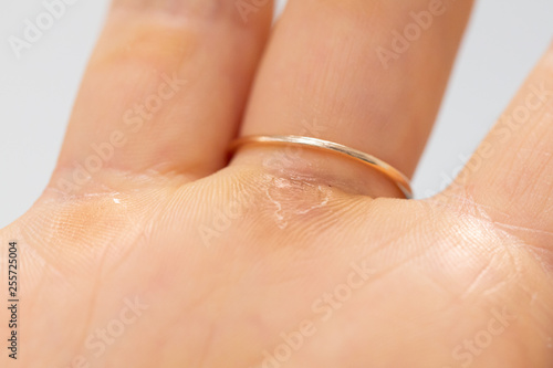 Macro of callus in the hand skin of a woman