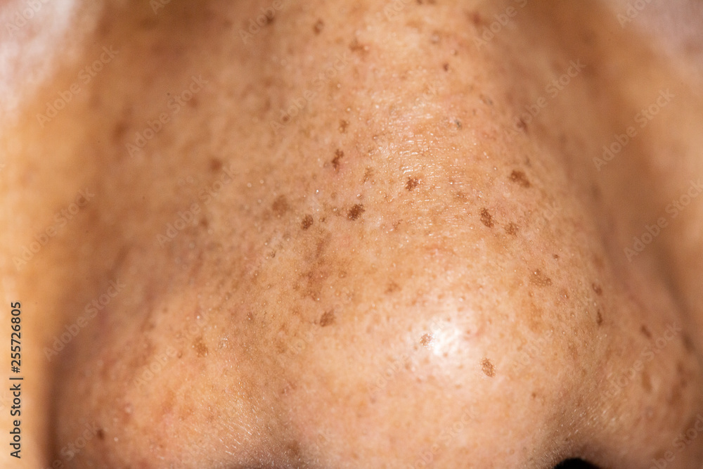 Fototapeta premium Blackheads in the skin of the nose