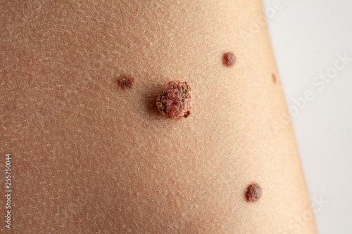 Foto Birthmark that needs to be removed.