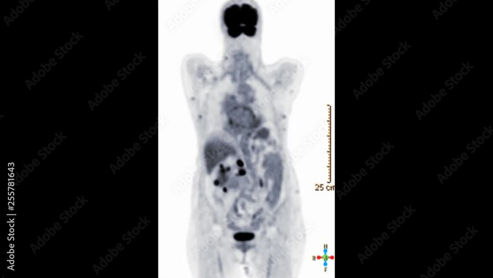 Positron Emission Tomography or PET CT scan of whole human body 3d rendering image coronal view. Positron Emission Tomography or PET CT scan of whole human body 3d rendering image coronal view.