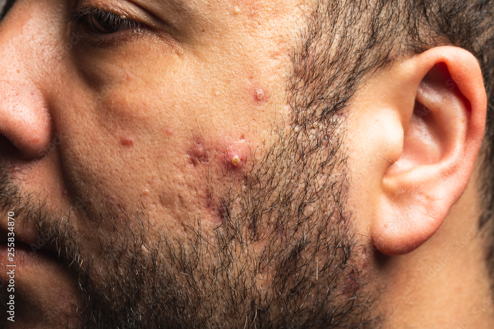 Obraz premium Close-up of acne on the skin, Acne on the face , wrinkle and acne inflammation on the face skin