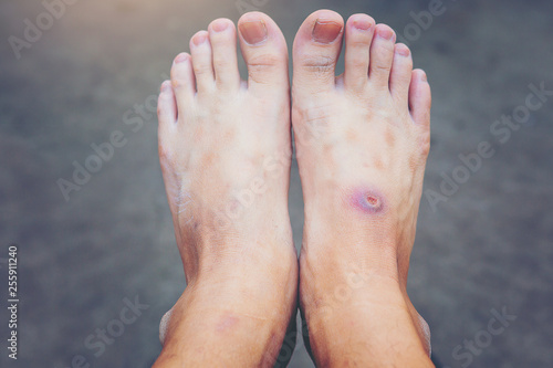 Tableau sur toile wound of beginning diabetic foot compare with normal foot.