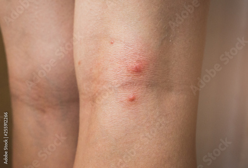 Mosquito bite on woman's leg. Skin health problem. Red pimple. © Vadym