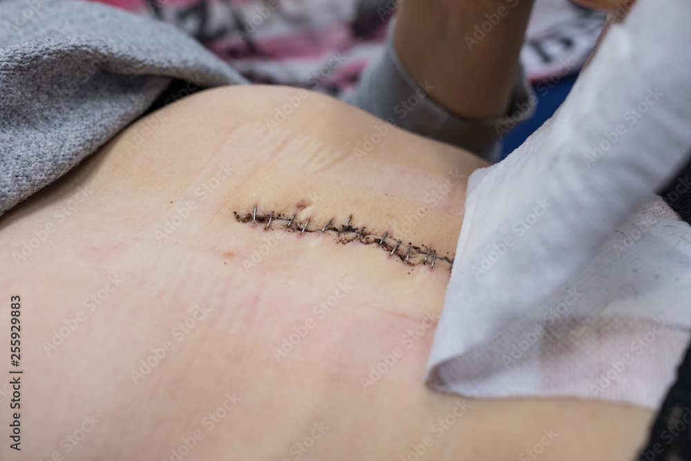 Obraz premium Klammernarbe am Bauch