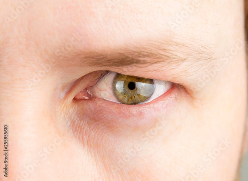Detail view of man green eye with heavy upper eyelid. Before Blepharoplasty surgery to correct Dermatochalasis concept.
