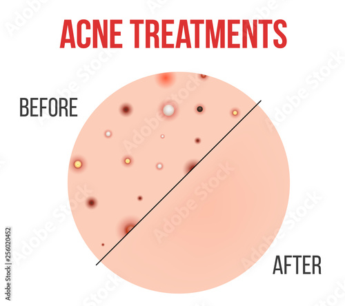 Creative vector illustration types of acne, pimples, skin pores, blackhead, whitehead, scar, comedone, stages diagram isolated on transparent background. Art design . Abstract concept graphic element