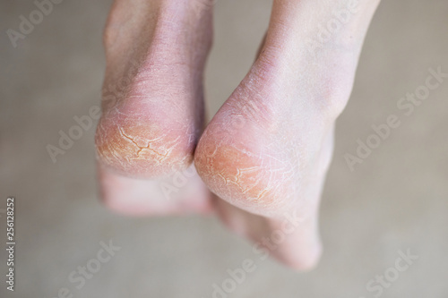 Close up cracked heels. Health problems with skin on feet