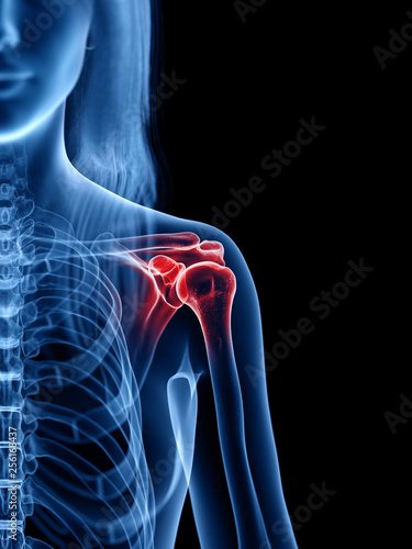 3d rendered medically accurate illustration of a painful shoulder