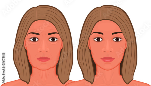 Vector illustration of a face lift surgery before and after procedure. For advertising of plastic surgery, medical and beauty publications