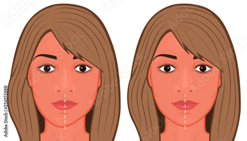 Vector illustration of a Jaw asymmetry correctiom surgery. For advertising of plastic surgery, medical and beauty publications