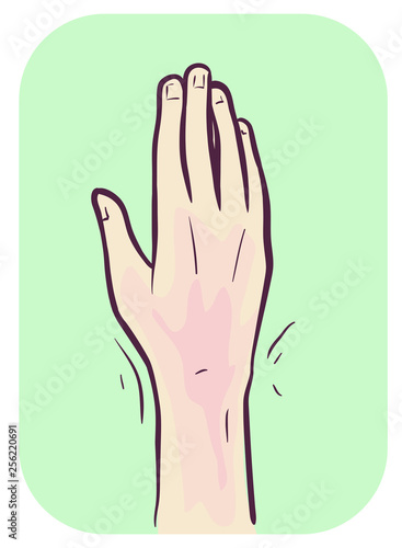 Hand Symptom Wrist Pain Ill...