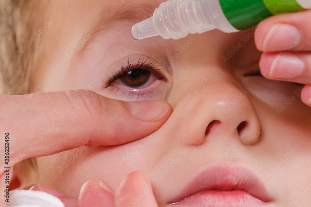 Eye child allergy and conjunctivitis red allergic,  medicine.