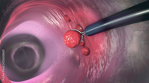 Obraz na plátne Removal of a colonic polyp with a electrical wire loop during a colonoscopy - 3d