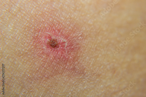 closeup of Chickenpox (varicella) on the skin in the final stages