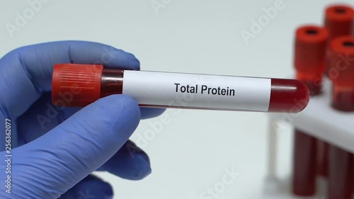 Total Protein, doctor holding blood sample in tube close-up, health check-up