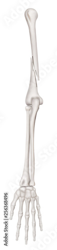 Humerus Fractures or Broken Arm completed displaced fracture type Anterior view- 3D medical and Biomedical illustration- Healthcare- Human Anatomy and Medical Concept -Isolated on white background.