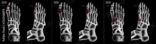 X-ray of collection arthritis big toe joint foot bone red highlights in different pain area- Anterior and Lateral view-3D medical and Biomedical illustration- Medical Concept-Isolated black background