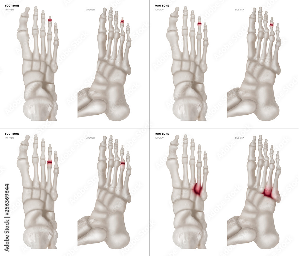 Collection Arthritis in Ring toe joint foot bone red highlights on