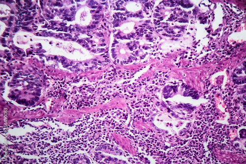 Gastric adenocarcinoma, light micrograph, photo under microscope