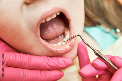 Pediatric dentistry. Pulling out a loose tooth close-up