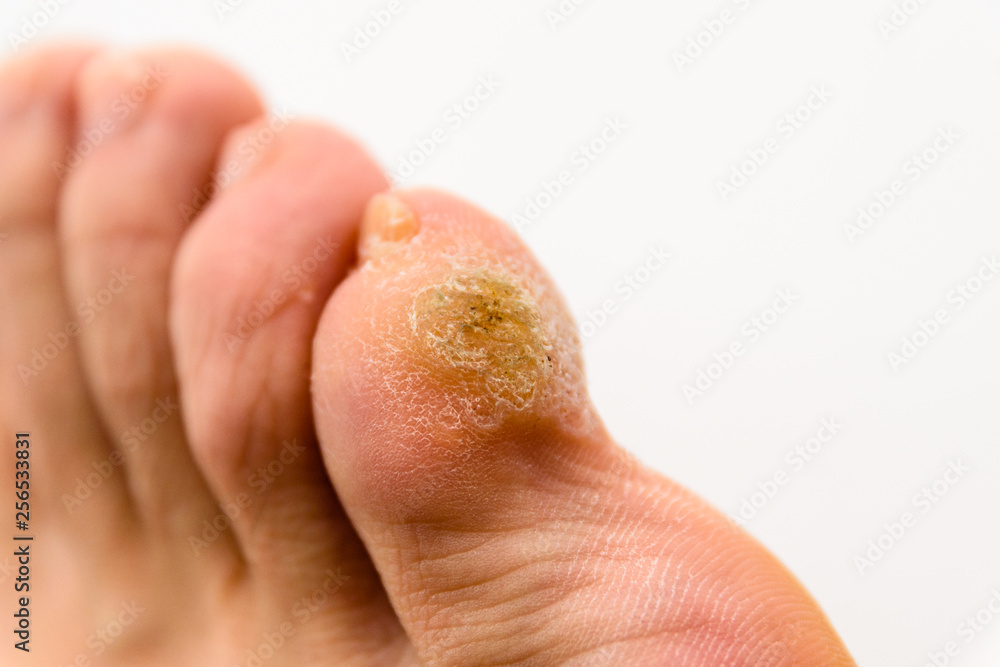 Warts on Foot and Toes Warts on Foot and Toes