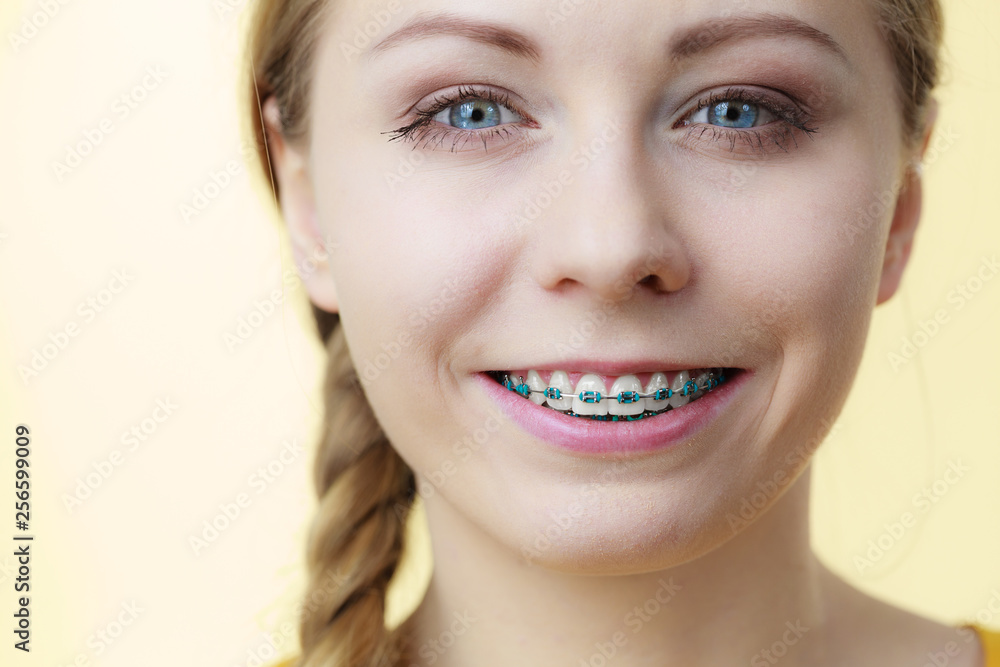Young woman showing teeth braces Young woman showing teeth braces