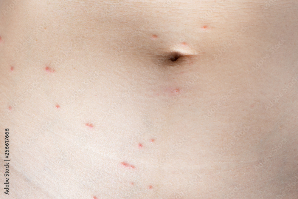 Fototapeta premium Close up of skin around navel been bitten by ticks..Tick bites cause the skin around the bite to become red,swollen and itchy..