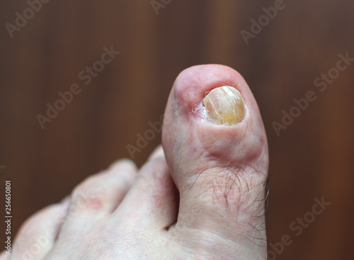 Medical photo: a deformed toe and skin condition - left foot. Old injury after accident. Dark background.