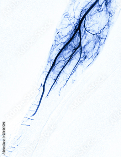 Angiography of brachial artery or fluoroscopic image of Vessel in the arm isolated on white background  in intervention radiology room. photo