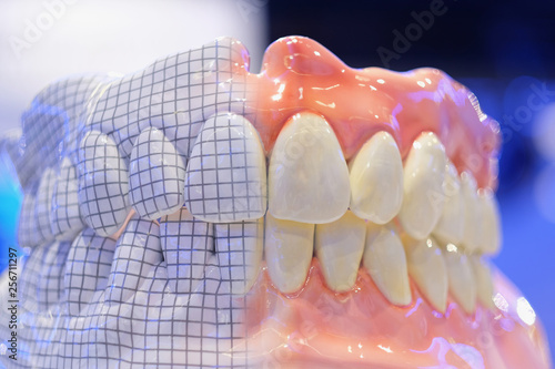 Samples of removable total prostheses of the upper and lower jaws