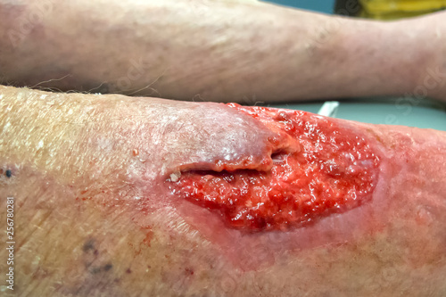 Granulating leg wound on a senior man in Tropical North Queensland, Australia photo